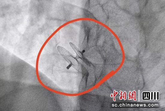 放置好的封堵傘。榮縣融媒 供圖 放置好的封堵傘。榮縣融媒 供圖