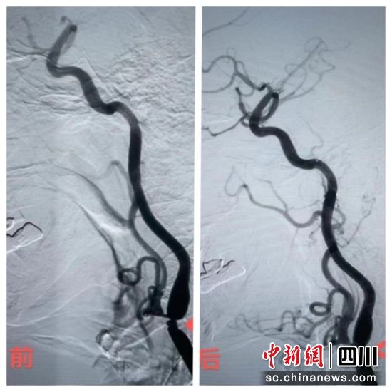 患者手術前和手術后對比圖。曹娜 攝 患者手術前和手術后對比圖。曹娜 攝